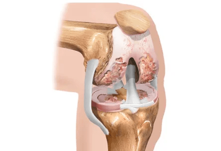 Arthrosis or arthritis difference