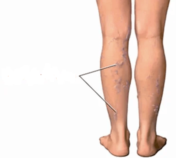 Consequences of the knee arthrosis