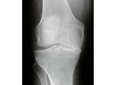 Diagnosis of arthrosis knee joint