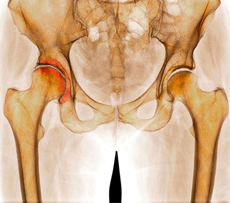 Hook's wrist arthrosis