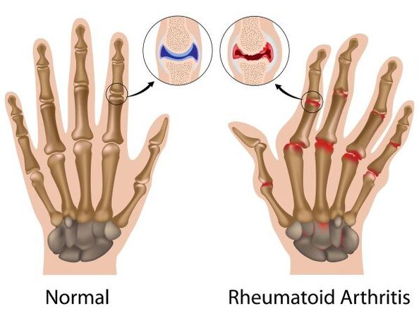 Finger compounds without pathology and rheumatoid arthritis