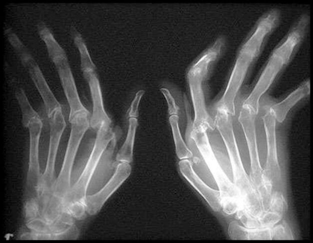 X -ray painting hands affected by arthrosis