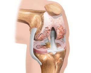 initial stage of knee osteoarthritis