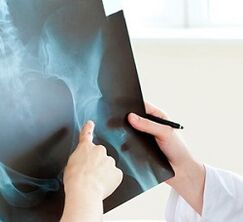 How to treat the hip joint arthrosis