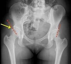Methods for treatment Arthrosis hip joint