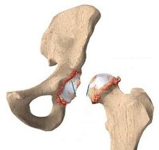 Reasons for developing the Arthrosis of the hip joint