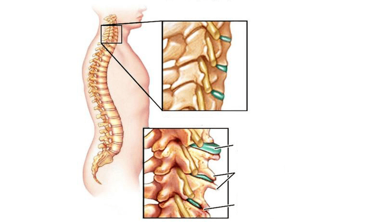 OsteoHondrosis Syndrome
