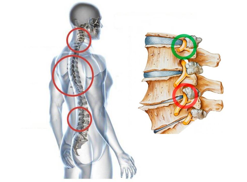 What does cervical osteochondrosis of vertebrae look like