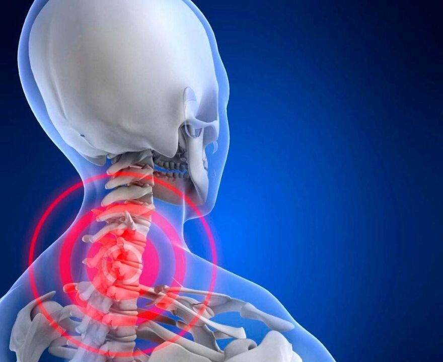 neck pain with cervical osteochondrose