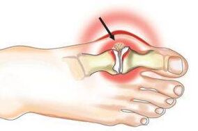 Damage common about arthritis and arthrosis