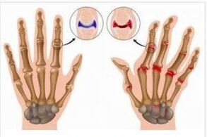 Differences between arthritis and armrose
