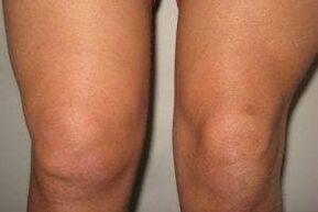 Inflammation in the knee joint with arthritis and arthrosis