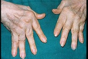 Symptoms of arthritis in your fingers