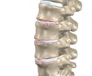 development of osteochondrosis of the spine
