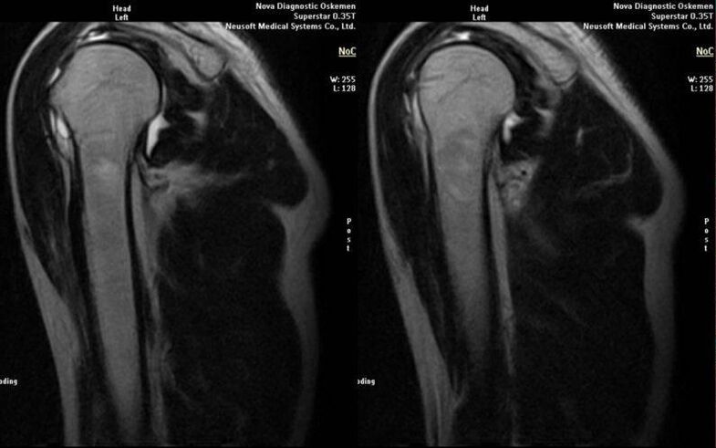 shoulder joint arthrosis on X-ray
