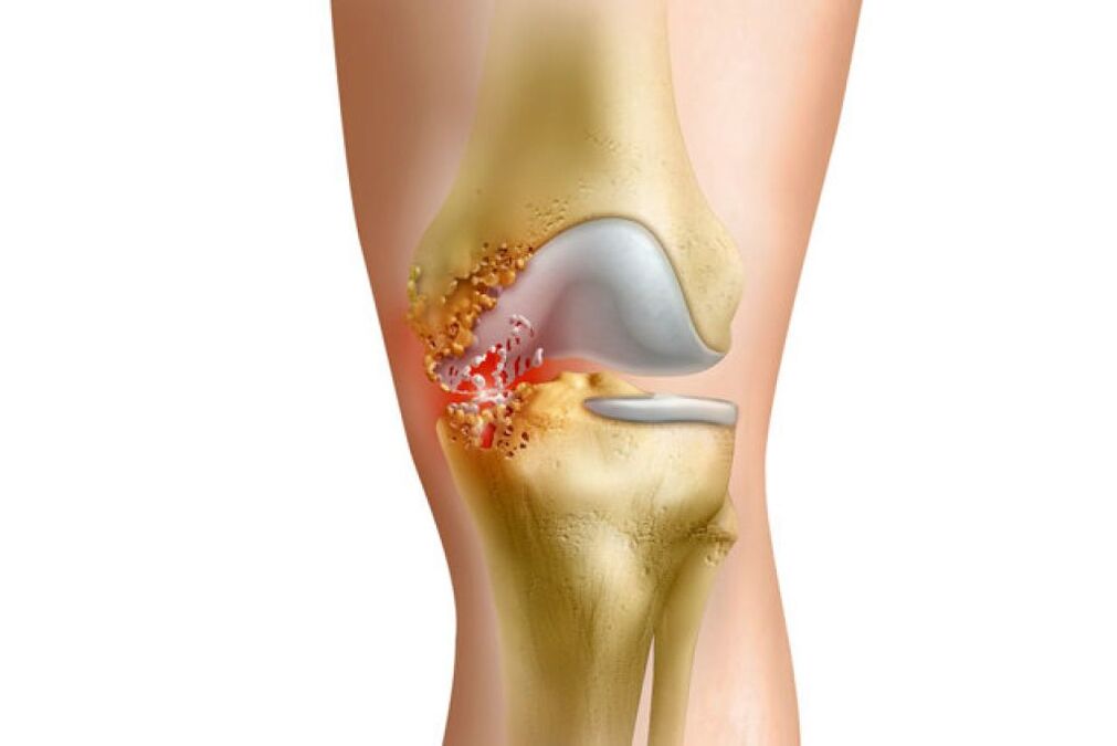 inflammation as a cause of pain in the hip joint