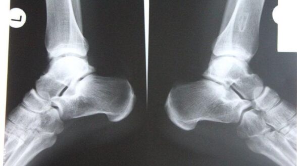 Diagnosis of arthrosis of the ankle joint using radiography