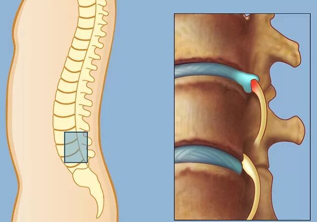 Rook syndrome
